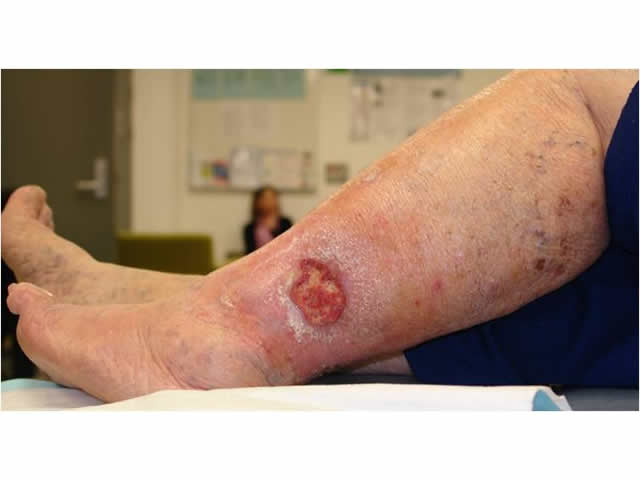 M3 01 Venous leg ulcer