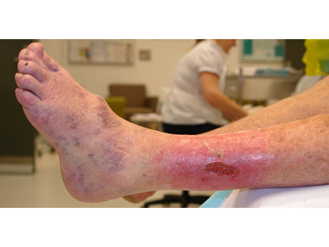 M3 02 Appearance of venous leg ulcer wound bed