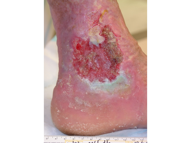M3 03 Flat, irregular wound margin