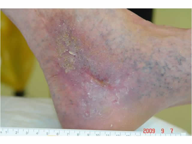 M3 05 Telegectasia or ankle flare