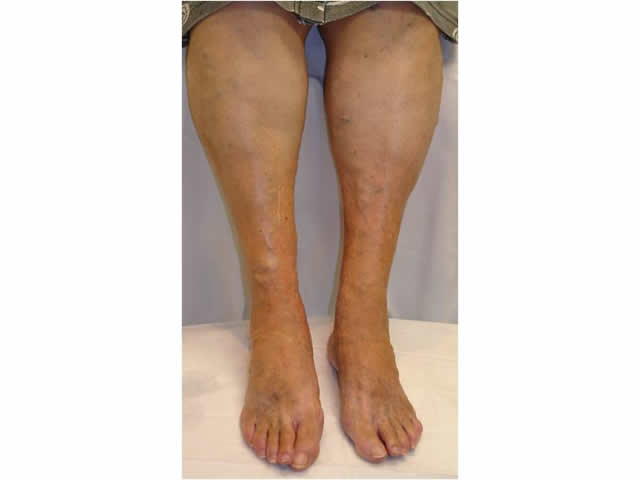 M3 06 Varicose veins