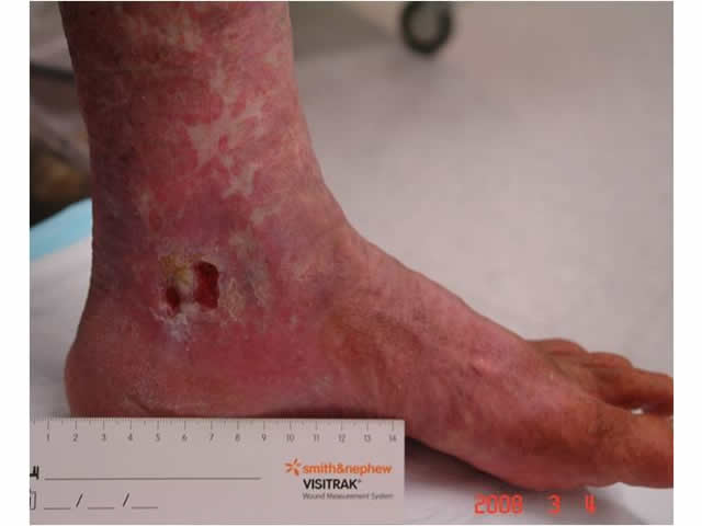 M3 08 Atrophie blanche above ulcer