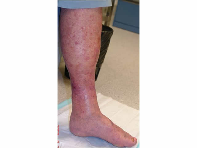 M3 10 Hyperpigmentation