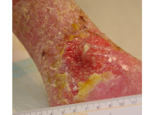 M3 11 Hyperkeratosis