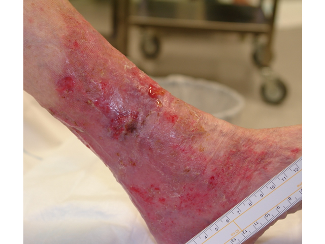 M3 12 Venous stasis eczema