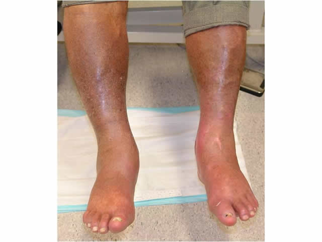 M3 13 Haemosiderin staining