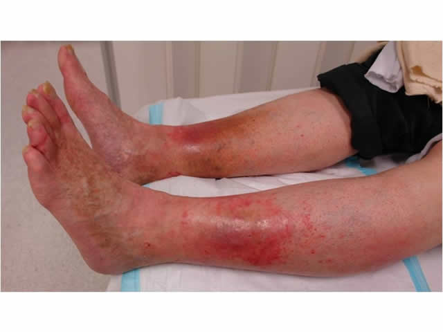 M3 14 Lipodermatosclerosis