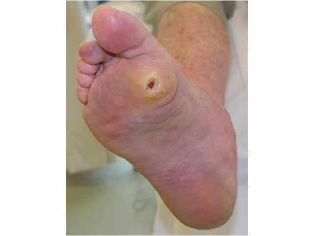M5 05 Callous surrounding wound