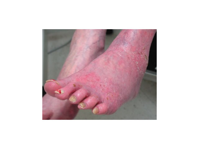 M5 09 Redness in dependent position