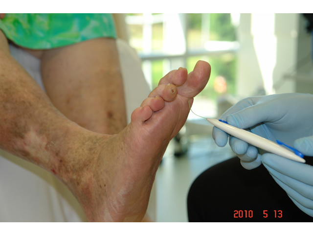 M5 11 Monofilament testing