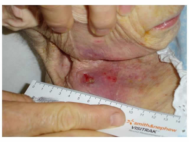 M6 01 Pressure ulcer on collar bone