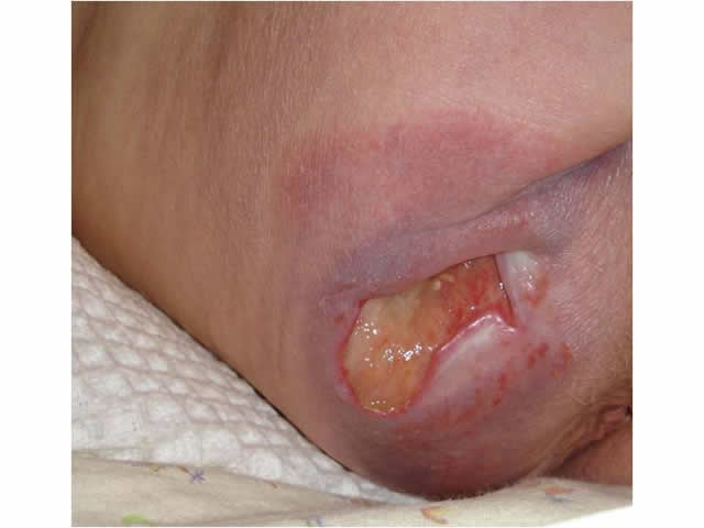 M6 04 Stage 3 pressure ulcer