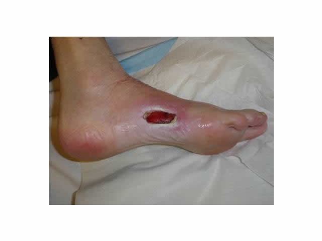 M6 05 Stage 4 pressure ulcer