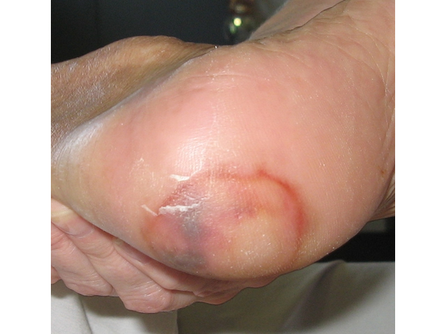 M6 06 Suspected deep tissue injury