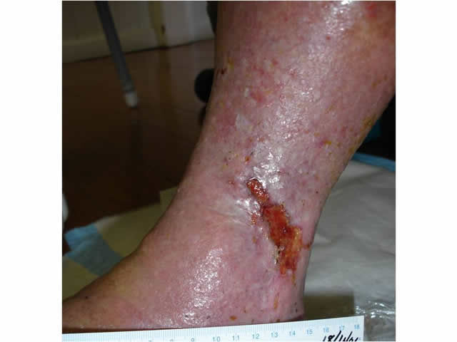 M7 15 Venous leg ulcer