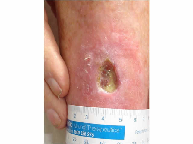 M7 16 Arterial leg ulcer
