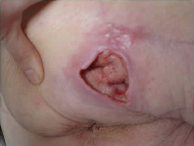 M7 17 Pressure ulcer