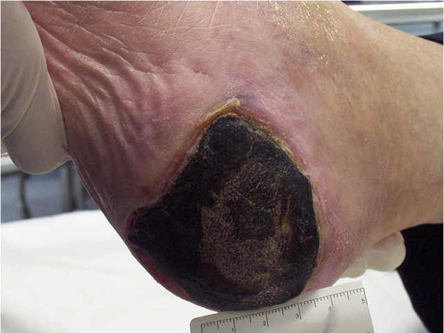 M7 20 Black necrotic wound