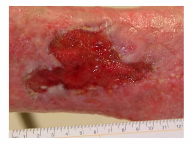 M7 22 Red granulating wound