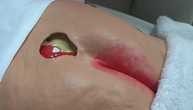 M7 V01 Principles of wound assessment